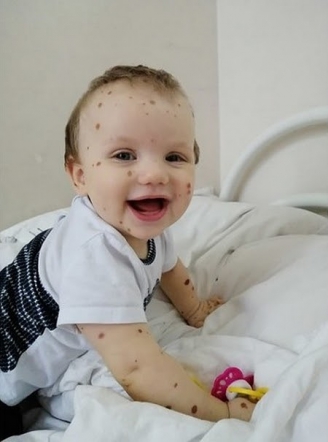 Первая операция по удалению невуса прошла успешно